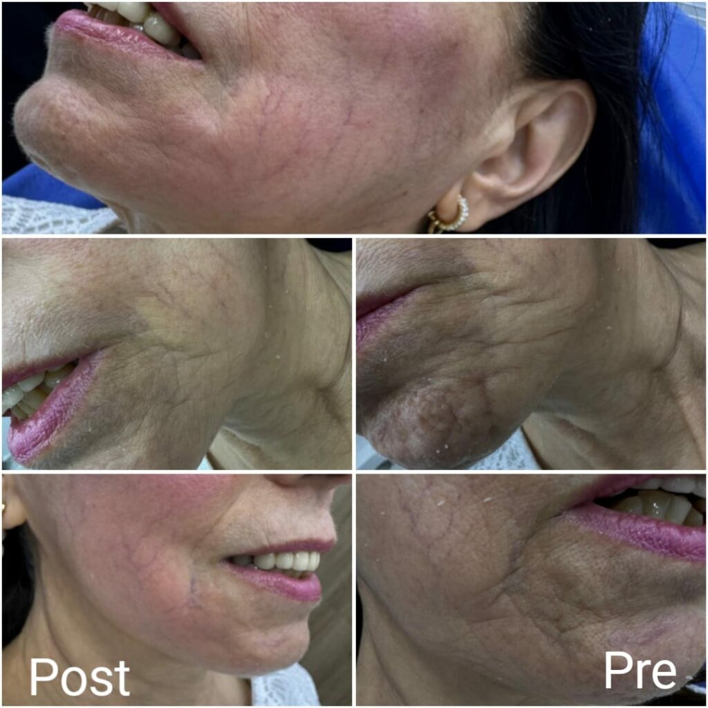 تحسين تجاعيد الوجه بحقن الراديس